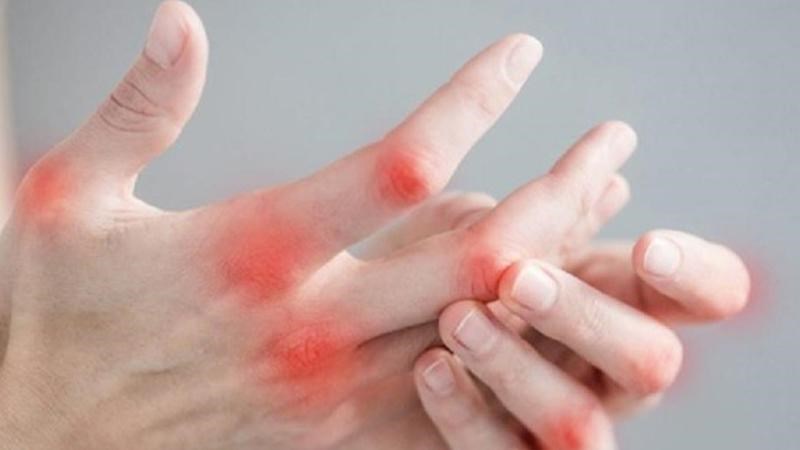 Thiên niên kiện có tác dụng mạnh gân cốt, trừ phong thấp, tiêu sưng, chỉ thống