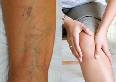 Nhìn thấy ai có “gân xanh” nhất định phải nói cho họ biết điều này, vì sẽ cứu sống họ đấy