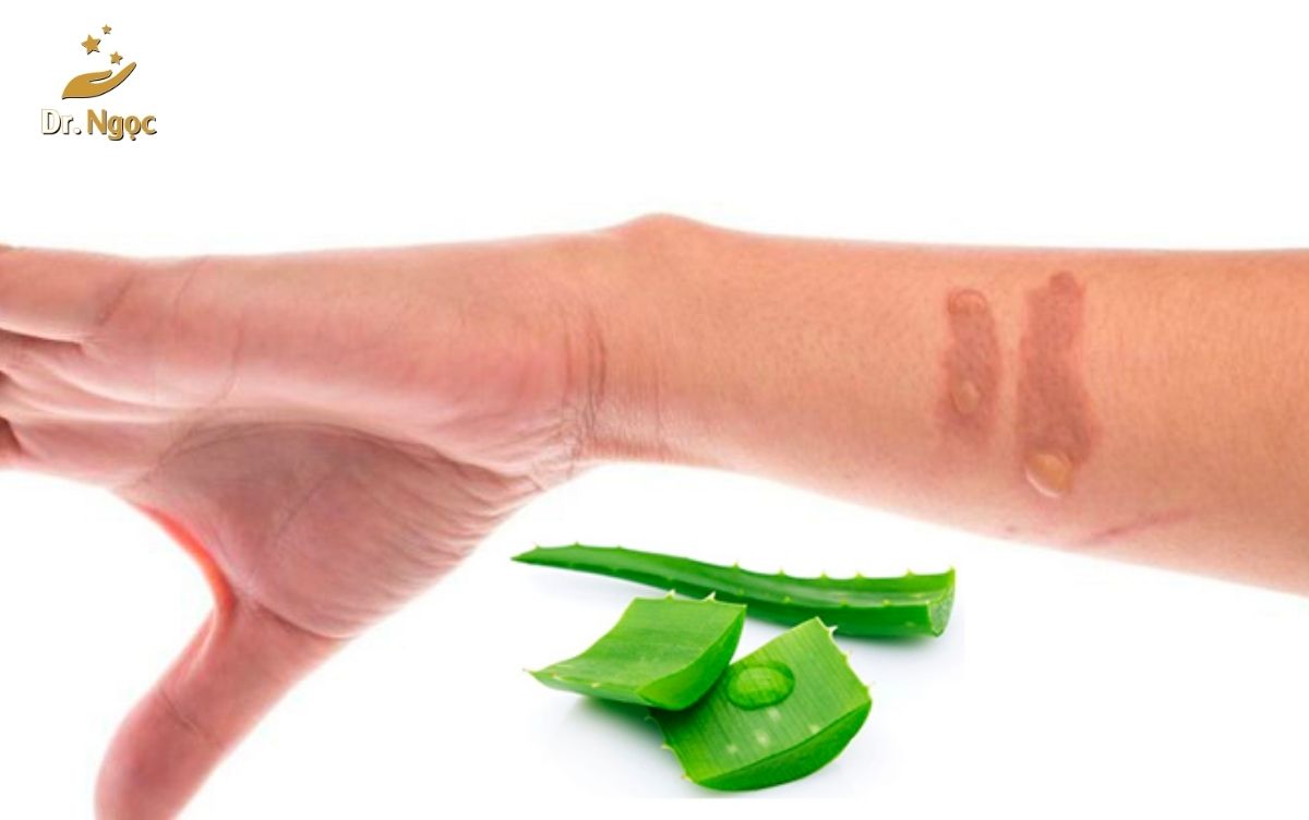 Nha đam xử lý vết bỏng dr ngọc