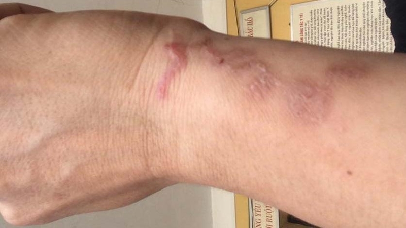 Mách bạn các bài thuốc dân gian trị bệnh sán chó hiệu quả bất ngờ 2