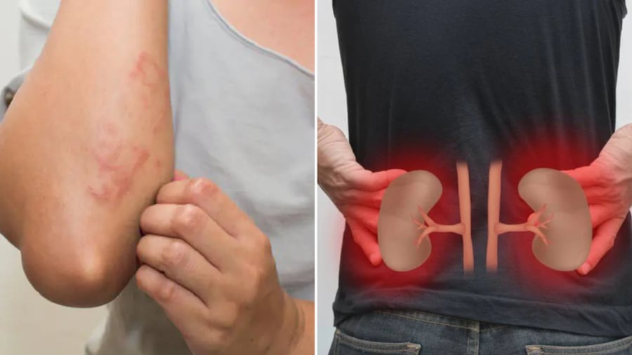 Thường xuyên mẩn ngứa hoặc đau vùng ngang thắt lưng là những dấu hiệu cảnh báo bệnh thận mà bạn phải chú ý.